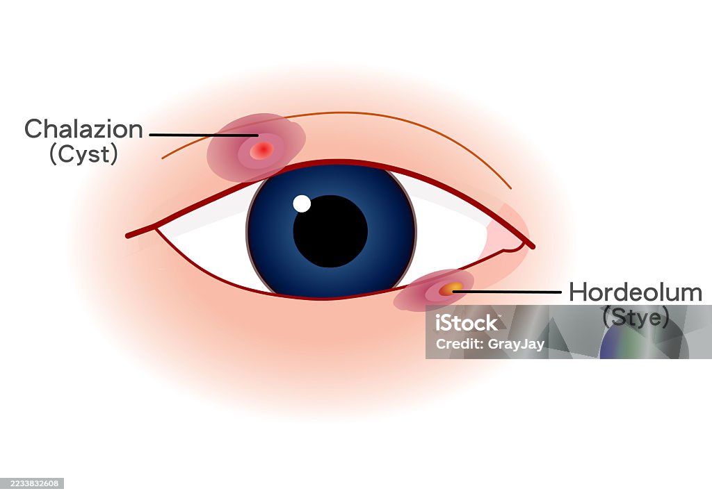 Eye Pain Specialist Aizawl